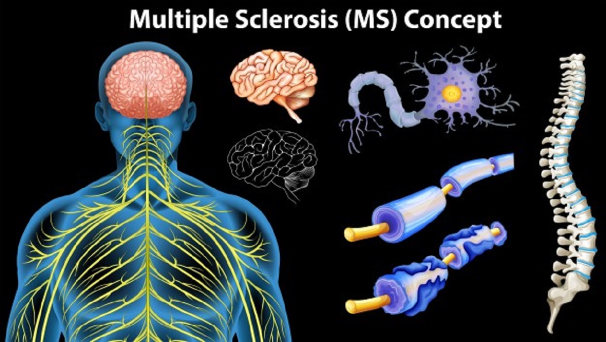 كيف شفيت من مرض التصلب اللويحي MS بالأعشاب والغذاء Multiple-sclerosis